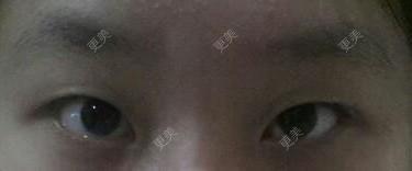 双眼皮