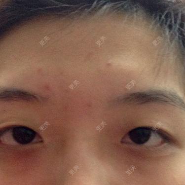 双眼皮