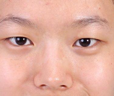 双眼皮