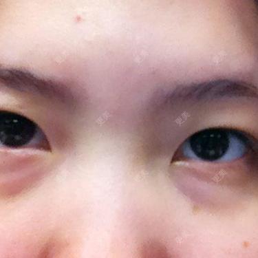 双眼皮