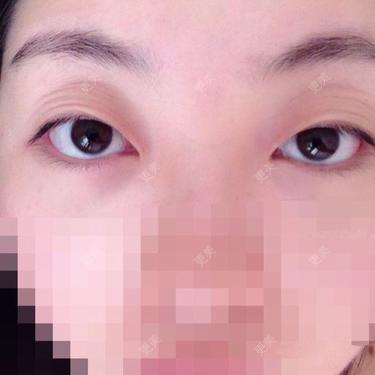 双眼皮