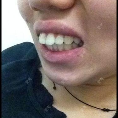 牙齿整形