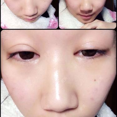 双眼皮