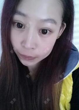 双眼皮