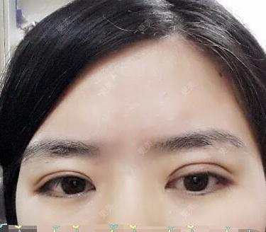 双眼皮