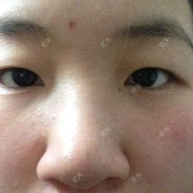 双眼皮