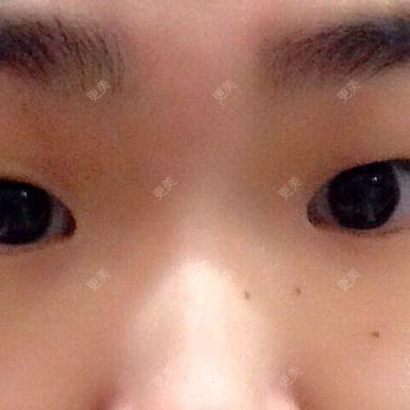 双眼皮