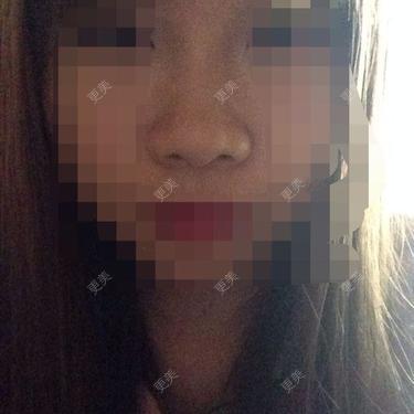 隆鼻