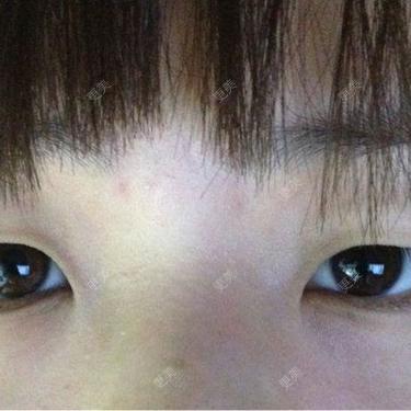 双眼皮
