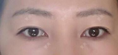 双眼皮