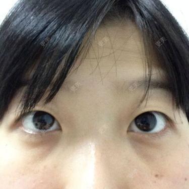 内双,眼睛圆,眼皮厚,求问这眼睛需要做哪些处理!可以埋线么!