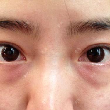 要疯了,跪求去除血管型黑眼圈的方法.很多年的顽疾了.今年23岁.