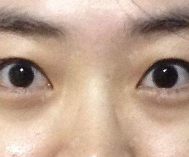 双眼皮