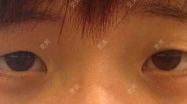 双眼皮