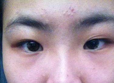 双眼皮