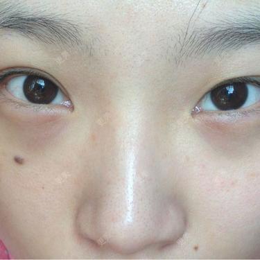 双眼皮不深眼角严重上翘左右不对称如题右眼明显比左眼高而且凤眼太