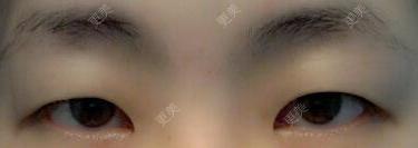 双眼皮