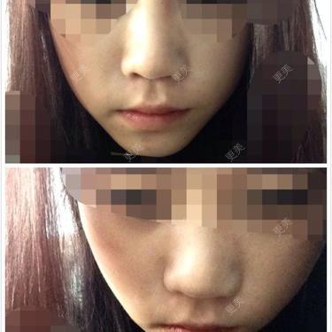 鼻翼