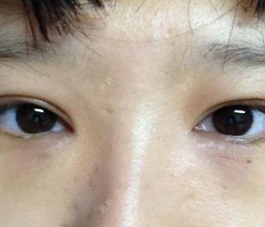 双眼皮