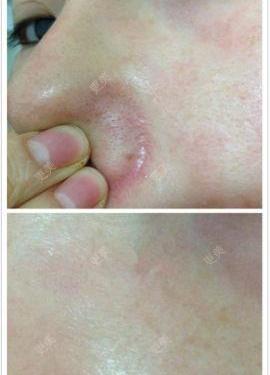 鼻沟(鼻翼两侧最深处)发红很多年了鼻沟处发红,不知道到底是螨虫还是