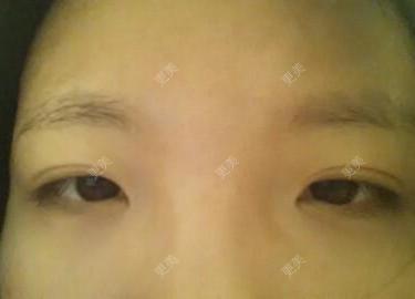 双眼皮