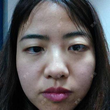 眼肌无力,做提拉手术因为我眼睛有点突出,眼裂长