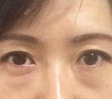 祛眼袋