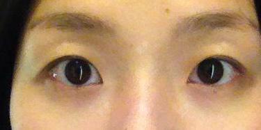 双眼皮