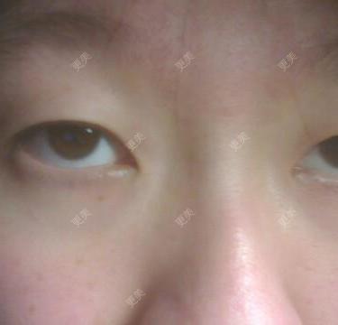 双眼皮