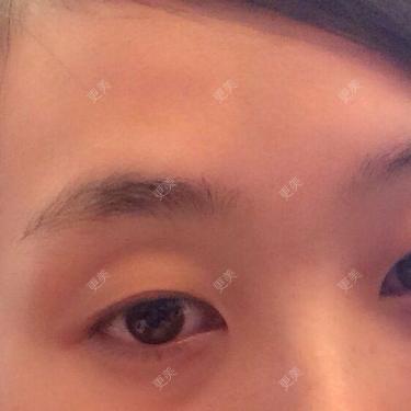 双眼皮