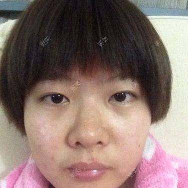 近视,眼睛难看求改善近视多年,眼睛无神而且很小,不好看