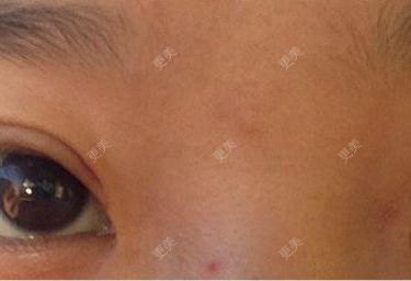 双眼皮