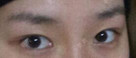 双眼皮