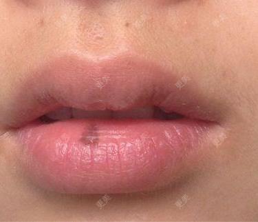 嘴唇上的斑如何去各位医生好,高中时下嘴唇长了深褐色淤斑,现在有六七