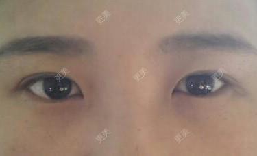 双眼皮