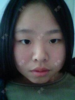 双眼皮