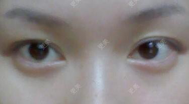 双眼皮