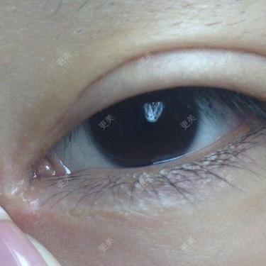 开眼角