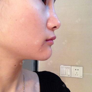 我刚注射玻尿酸填充下巴,下巴整个很圆,还有弧度,这个以后会消肿还是