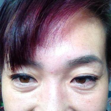 眼袋医生好我今年34岁生完宝宝眼袋皱纹特别严重该怎么办有医生见议外