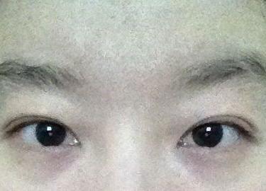 双眼皮