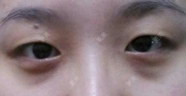 双眼皮