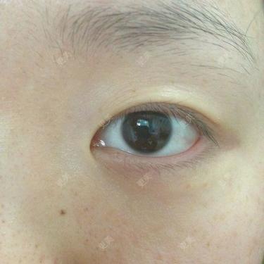 内眦赘肉会引起皱纹吗内眼角有皱纹沿着内眦赘肉一直延伸,上眼皮也被