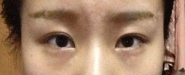双眼皮