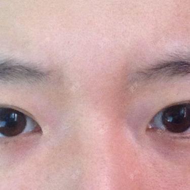 双眼皮