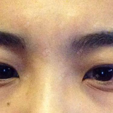 双眼皮