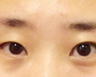 双眼皮