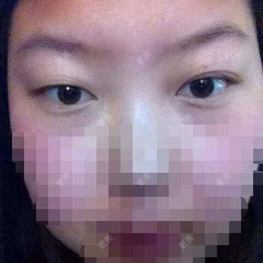 开眼角