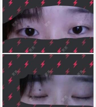 双眼皮