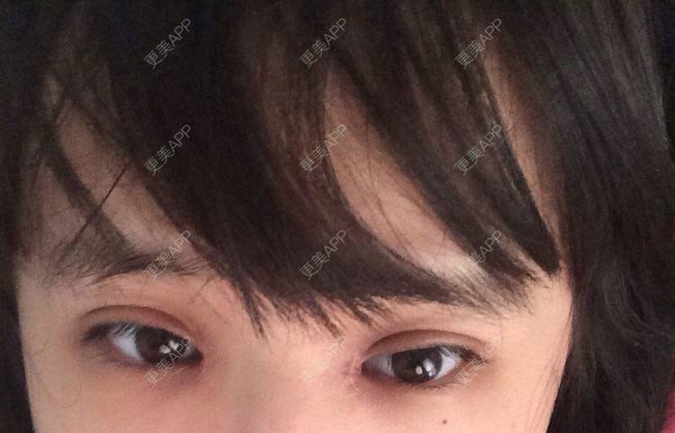 更美 - 切开和开眼角一个月不到一点！感觉右眼有点奇怪？ | 双眼皮 | 所长精选